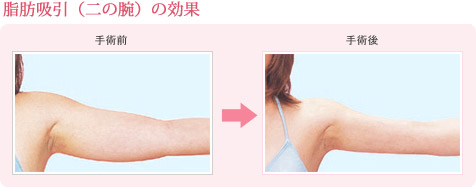 脂肪吸引(二の腕)の効果