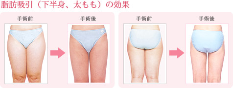脂肪吸引(下半身、太もも)の効果