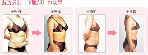 脂肪吸引(下腹部)の効果