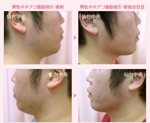男性ホホアゴ脂肪吸引