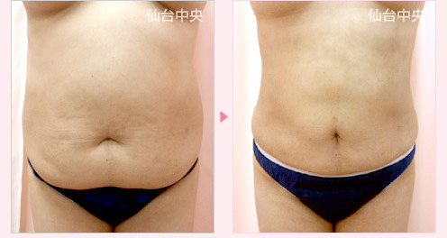 上腹部下腹部ウエスト脂肪吸引 症例写真1