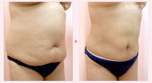 上腹部下腹部ウエスト脂肪吸引 症例写真2