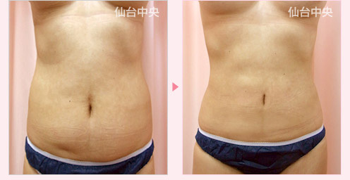 腹部腰部脂肪吸引 症例写真1
