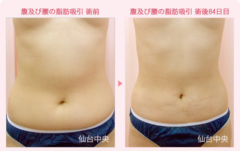 腹及び腰の脂肪吸引 症例写真1
