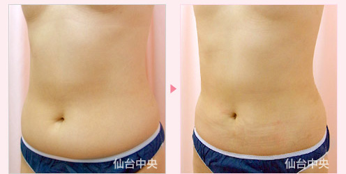 腹及び腰の脂肪吸引 症例写真3