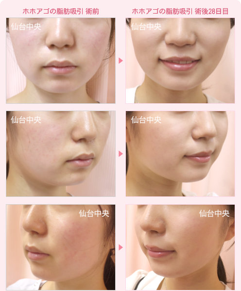 ホホアゴの脂肪吸引 症例写真3