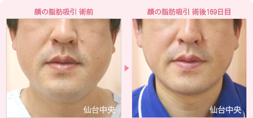 首、頬、顎の脂肪吸引 症例写真1