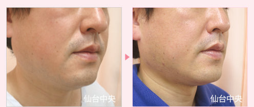 首、頬、顎の脂肪吸引 症例写真2