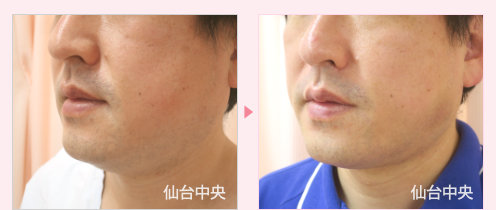 首、頬、顎の脂肪吸引 症例写真3