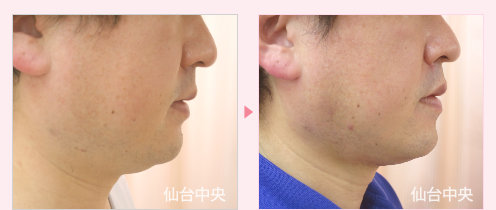 首、頬、顎の脂肪吸引 症例写真4