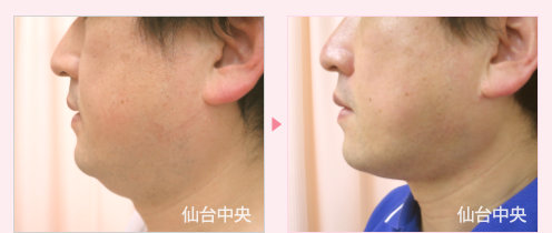 首、頬、顎の脂肪吸引 症例写真5