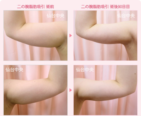 二の腕脂肪吸引 症例写真