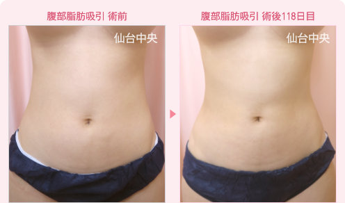 腹部脂肪吸引 症例写真1