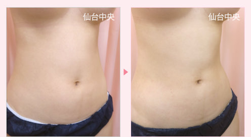 腹部脂肪吸引 症例写真2