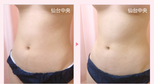 腹部脂肪吸引 症例写真3