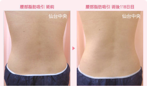 腰の脂肪吸引 症例写真1