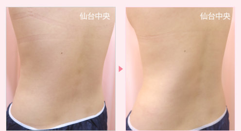 腰の脂肪吸引 症例写真2
