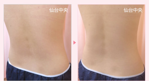 腰の脂肪吸引 症例写真3