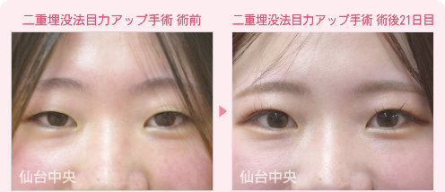 二重埋没法、目力アップ手術症例写真 - 術前と術後21日目の比較、正面