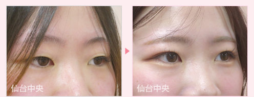 二重埋没法、目力アップ手術症例写真 - 術前と術後21日目の比較、右向き