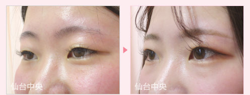 二重埋没法、目力アップ手術症例写真 - 術前と術後21日目の比較、左向き