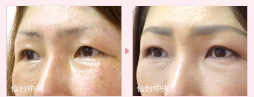 左眼瞼下垂修正手術 症例写真 - 術前と術後85日目の比較、左向き