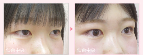 腫れない二重 症例写真 - 術前と術直後の比較、左向き