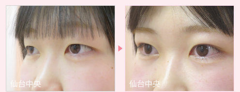 腫れない二重 症例写真 - 術前と術直後の比較、右向き