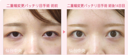 二重幅変更パッチリ目手術症例写真 - 術前と術後14日目の比較、正面