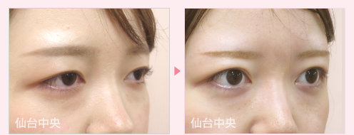 二重幅変更パッチリ目手術症例写真 - 術前と術後14日目の比較、右向き