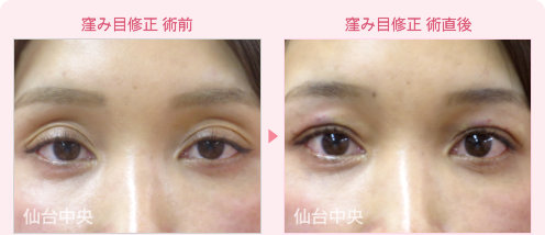 窪み目修正 症例写真 - 術前と術直後の比較、正面