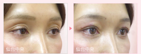 窪み目修正 症例写真 - 術前と術直後の比較、右向き