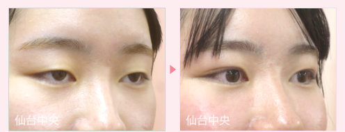 二重埋没法目力アップ手術 症例写真 - 術前と術後14日目の比較、右向き