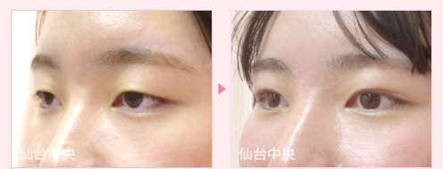 二重埋没法目力アップ手術 症例写真 - 術前と術後14日目の比較、左向き