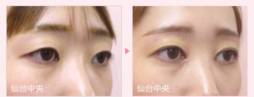 目頭切開、二重埋没法手術症例写真 - 術前と術後35日目の比較、右向き