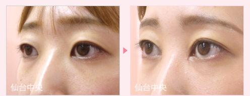 目頭切開、二重埋没法手術症例写真 - 術前と術後35日目の比較、左向き