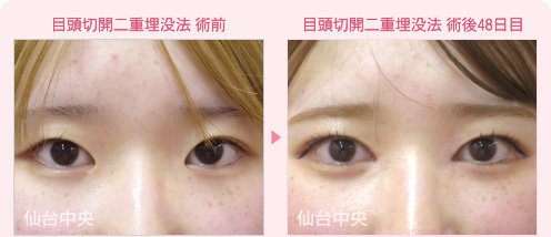 目頭切開、二重埋没法手術症例写真 - 術前と術後48日目の比較、正面