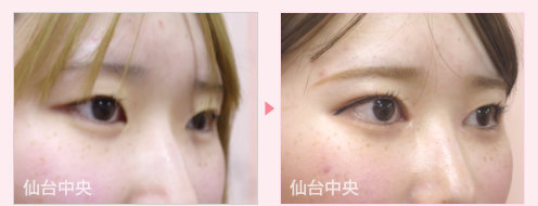 目頭切開、二重埋没法手術症例写真 - 術前と術後48日目の比較、右向き