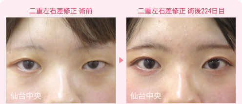二重左右差修正 症例写真 - 術前と術後224日目の比較、正面