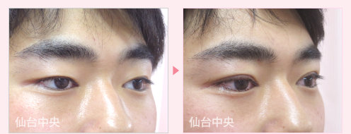 二重左右差修正、腫れない二重手術 症例写真 - 術前と術直後の比較、右向き