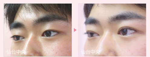 二重左右差修正、腫れない二重手術 症例写真 - 術前と術直後の比較、左向き