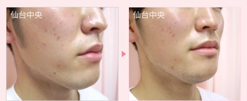 あご削り 症例写真2