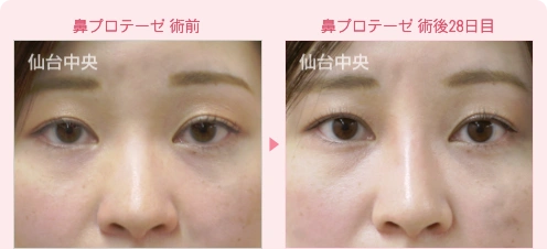 鼻プロテーゼ 症例写真1