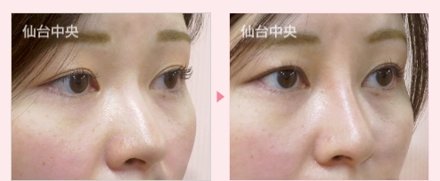 鼻プロテーゼ 症例写真2