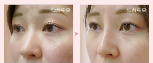 鼻プロテーゼ 症例写真3