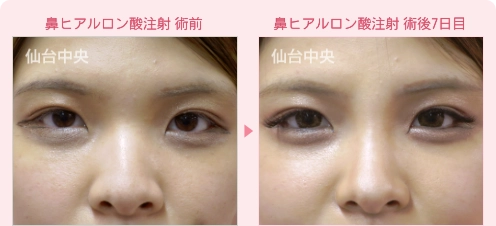 鼻ヒアルロン酸注射 症例写真1