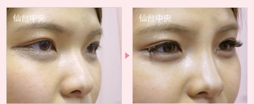 鼻ヒアルロン酸注射 症例写真2