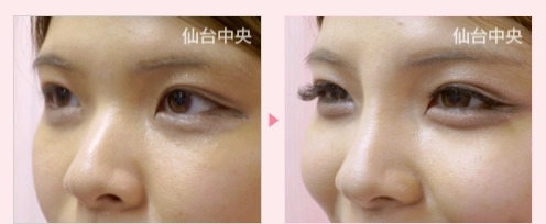 鼻ヒアルロン酸注射 症例写真3