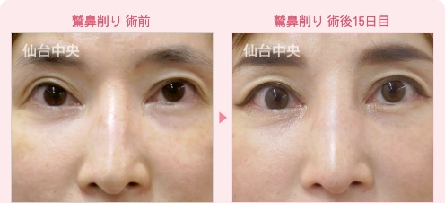 鷲鼻削り症例写真1