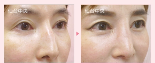 鷲鼻削り症例写真2